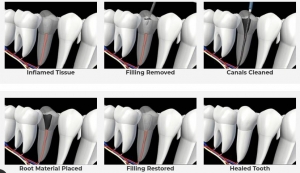 When Do you Need a Root Canal Retreatment? Relieving Dental Pain for Good